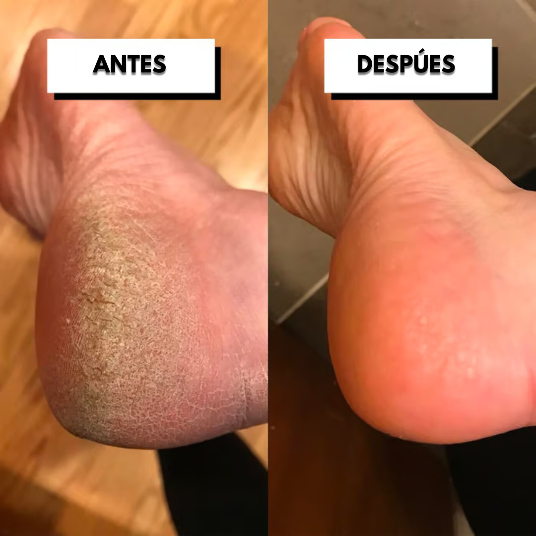 Pedicuure™: Removedor de Callos Electrico
