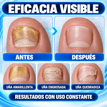DermoLux | Laser Antifungico Adios Hongos