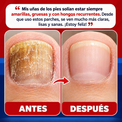 DermaPatch | Parche Antifungico Para Uñas
